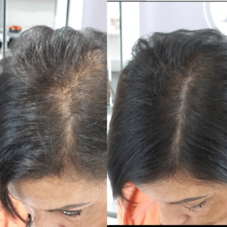 Thinning hair Smp treatment